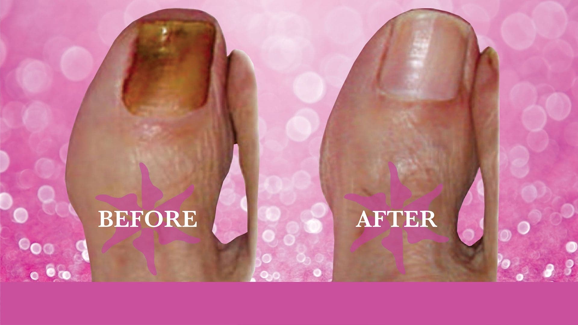 Dramatic before-and-after results from cosmetic foot surgery