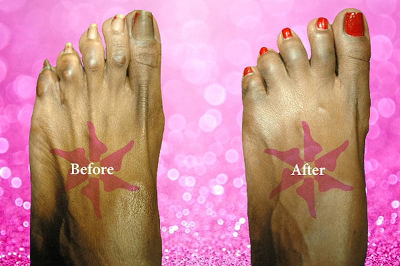 Hammertoe Correction — before and after, Toes