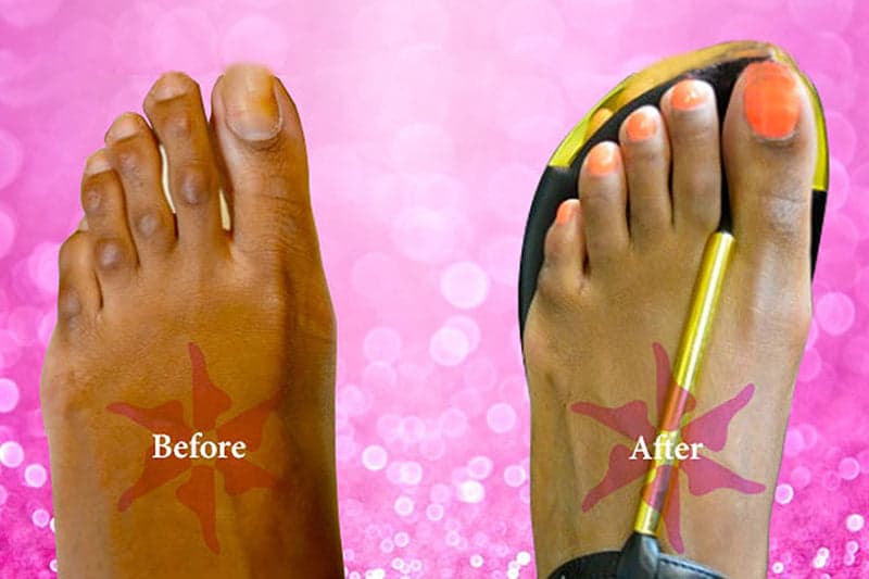 Toe Shortening before and after treatment